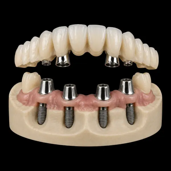 Implant-Assisted Telescopic Bridge