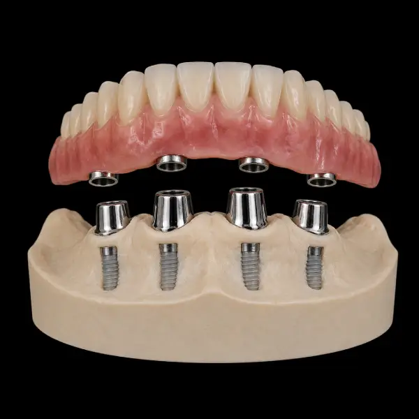 Implant-Assisted Telescopic Denture