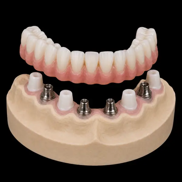 Implant-Assisted Zirconia Telescopic Crowns