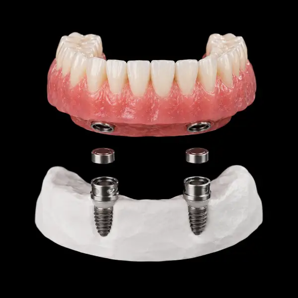 Implant Magnetic Attachment