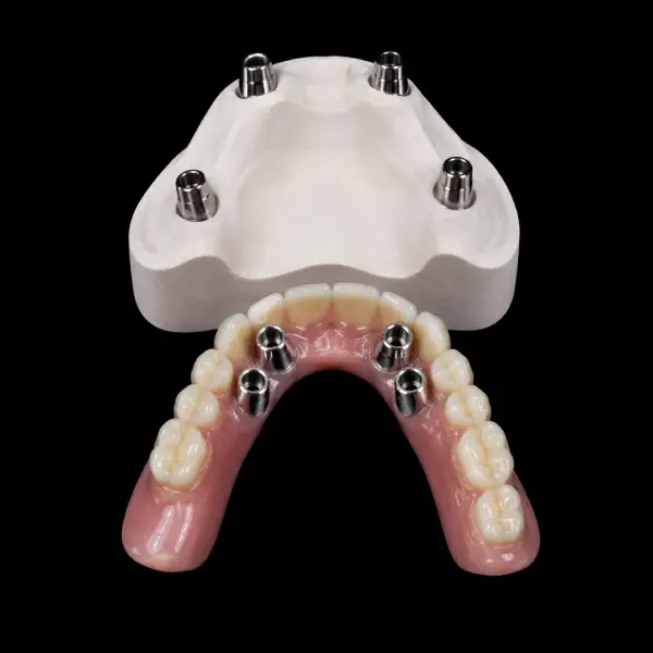 Implant-Supported Cobalt-Chrome Telescopic Crowns