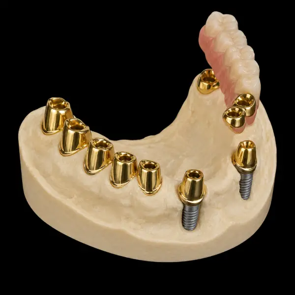 Implant-Supported Yellow Gold Telescopic Crowns