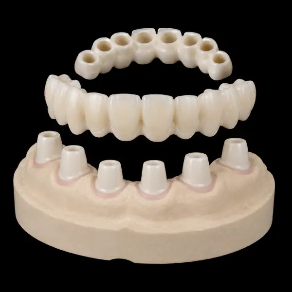 Implant-Supported Zirconia Telescopic Crowns