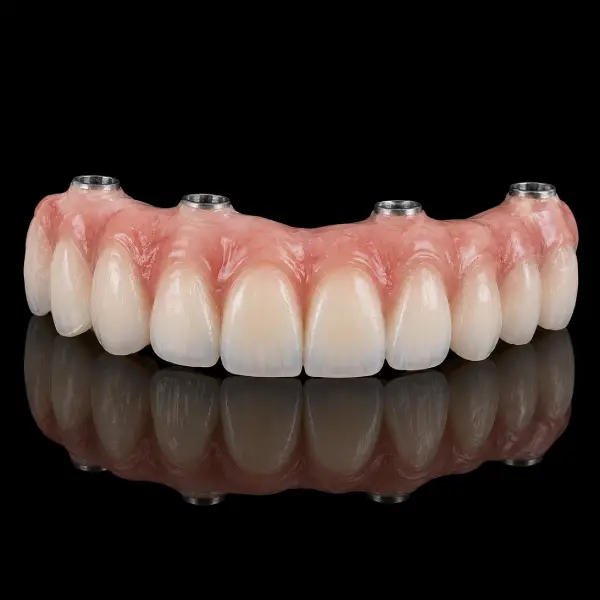 Layered Implant-Supported Zirconia Bridge