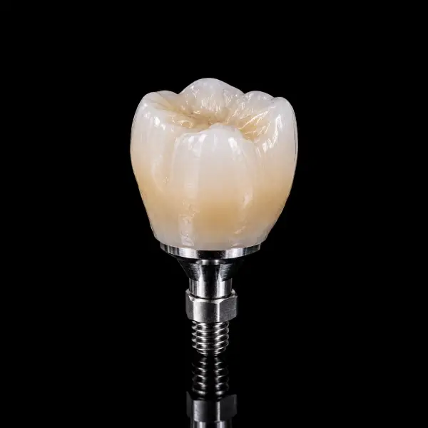 Layered Screw-Retained Zirconia Crown