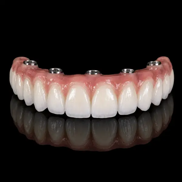 Layered Zirconia Implant Bridges
