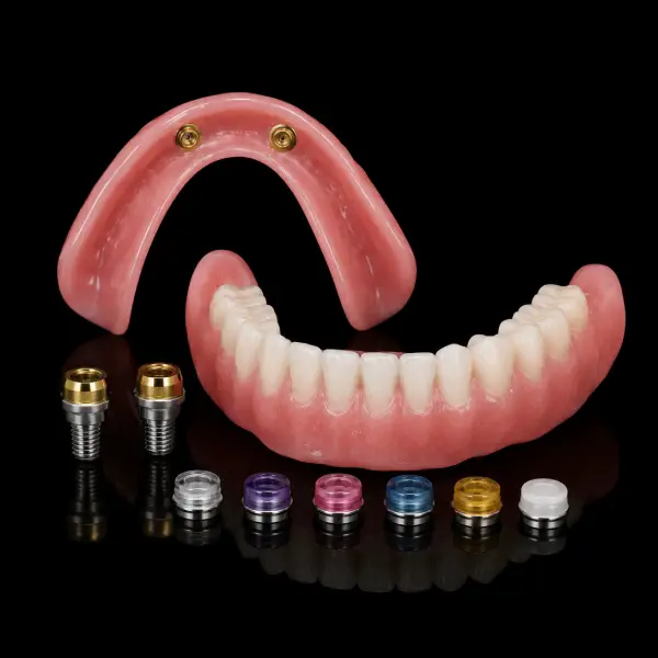 Locator Implant Overdenture