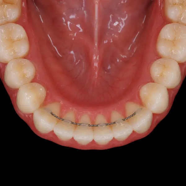 Lower Lingual Retainer