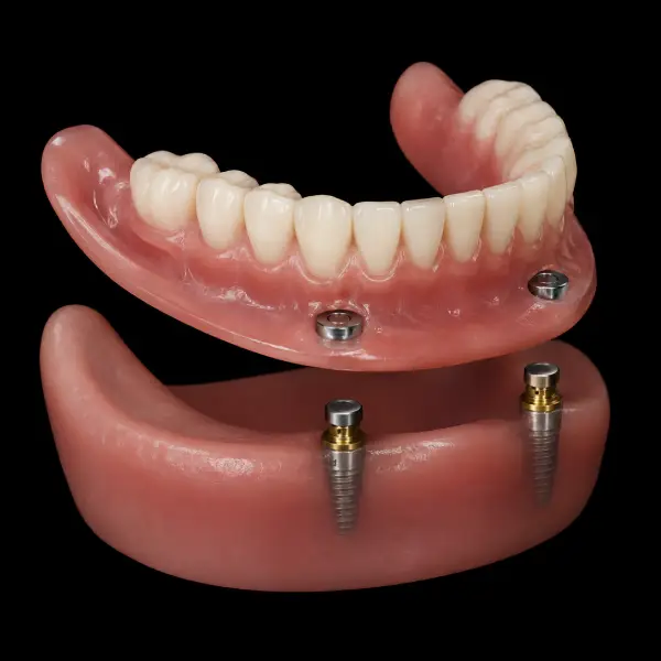 Magnetic Implant Overdenture