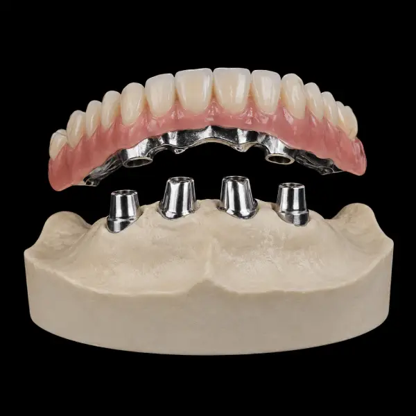 Metal Framework Telescopic Partial Denture