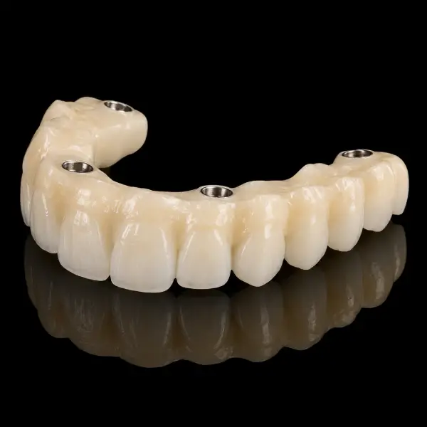 Monolithic Implant-Supported Zirconia Bridge