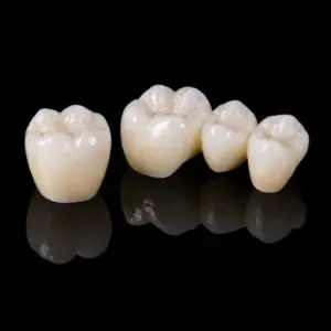 Multilayer Cement-Retained Zirconia Crown
