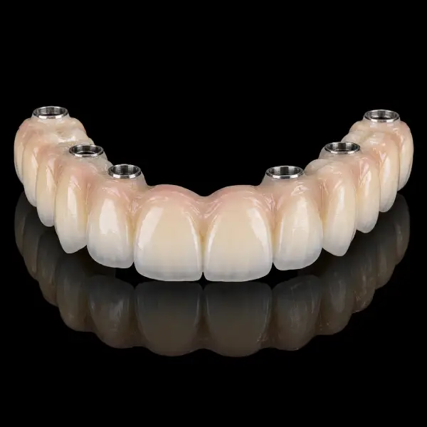 Multilayer Implant-Supported Zirconia Bridge
