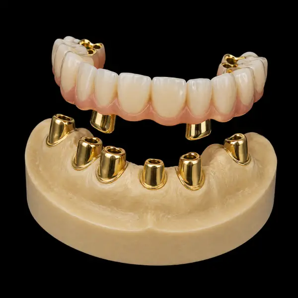 Resilient Yellow Gold Telescopic Crowns