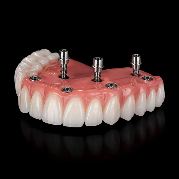 Screw-Retained All-on-46 Restoration