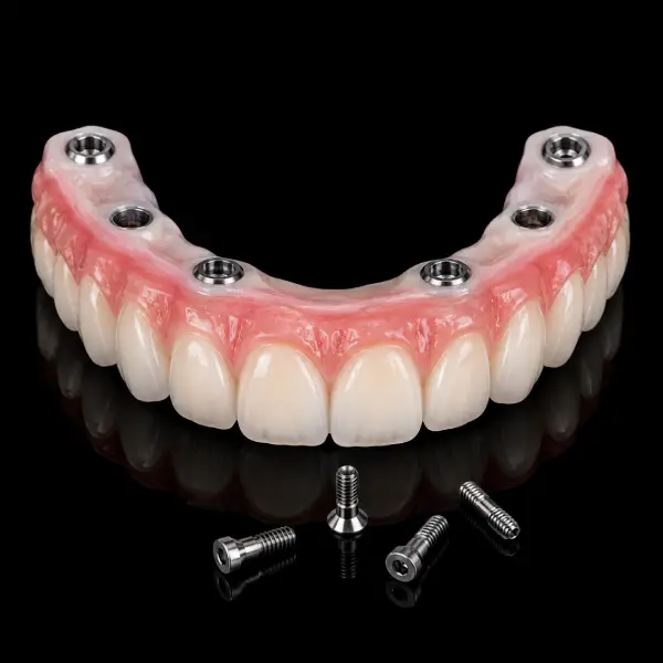 Screw-Retained Hybrid Denture
