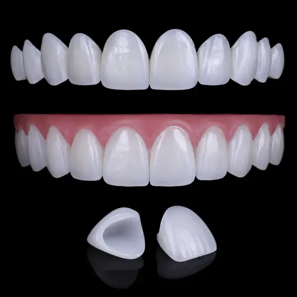 Standard E.max Veneers