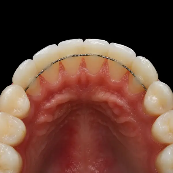 Standard Lingual Wire Retainer