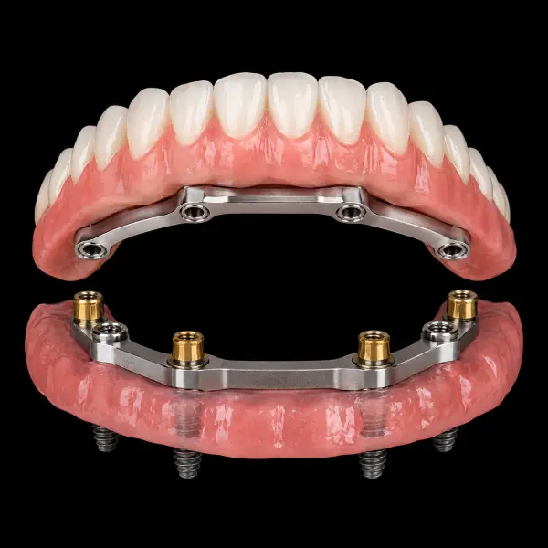 Titanium Bar Hybrid Denture