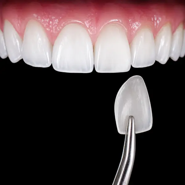 Ultra-Thin E.max Veneers