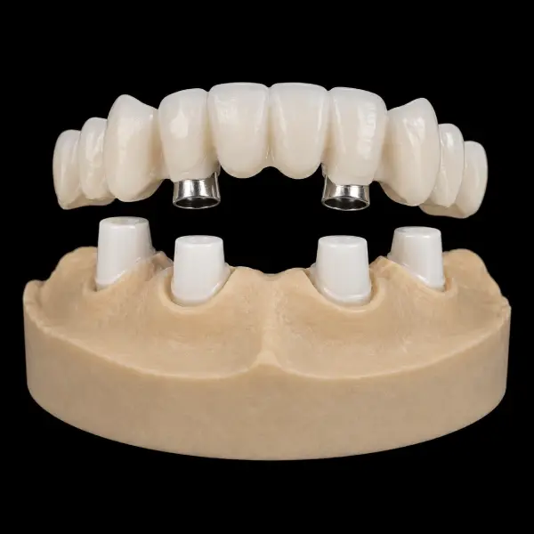 Zirconia Telescopic Bridge