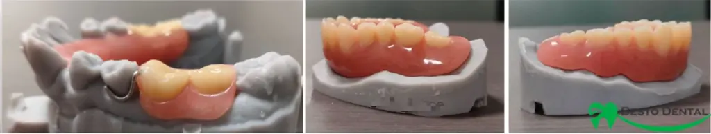 Full and Partial Dentures