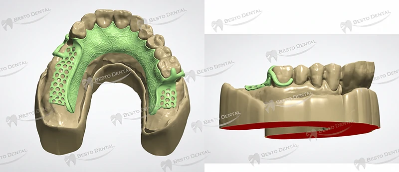  Cast Partial Frameworks and Economy Dentures