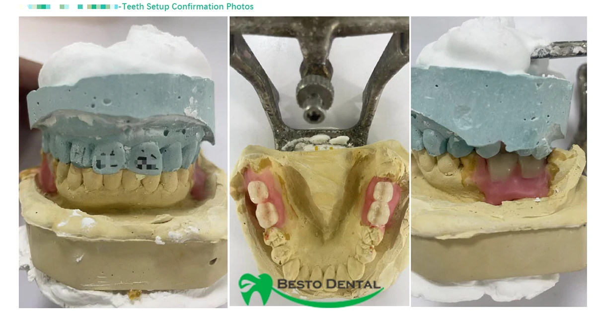 Dentures & Partials