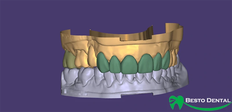 Designing the Veneer Shape