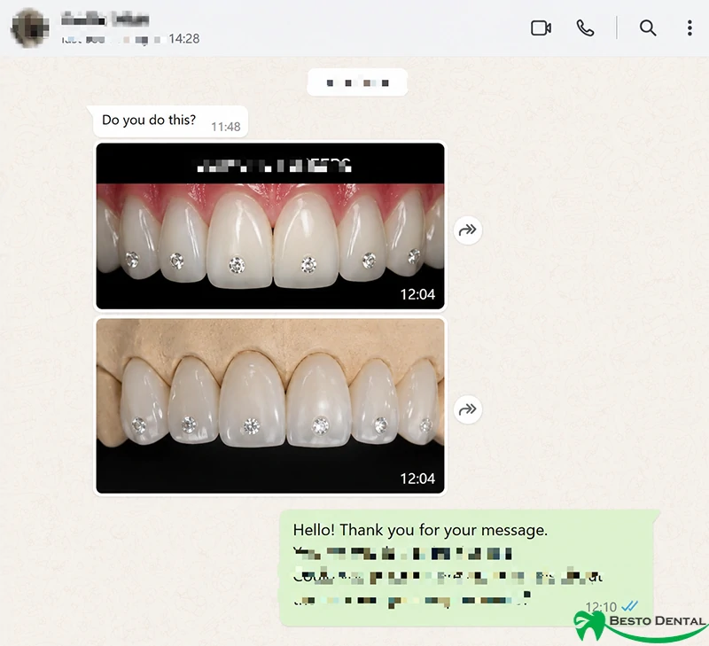 Diamond Veneers