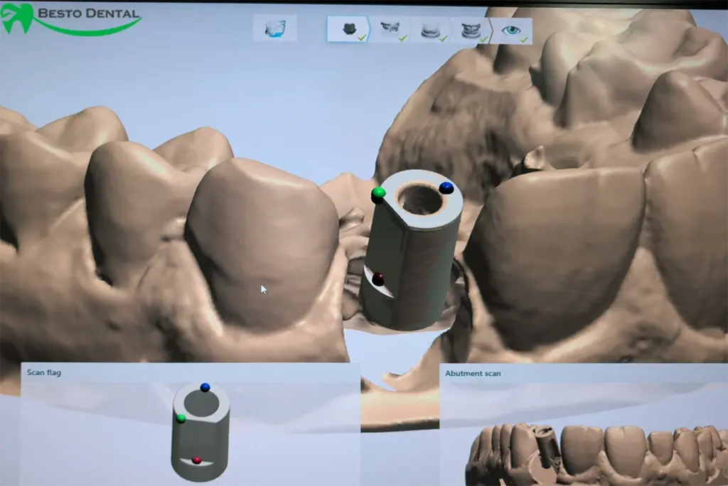 Implant Restorations