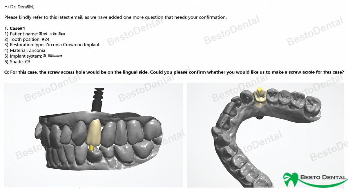 Retention Methods of Implant Crowns