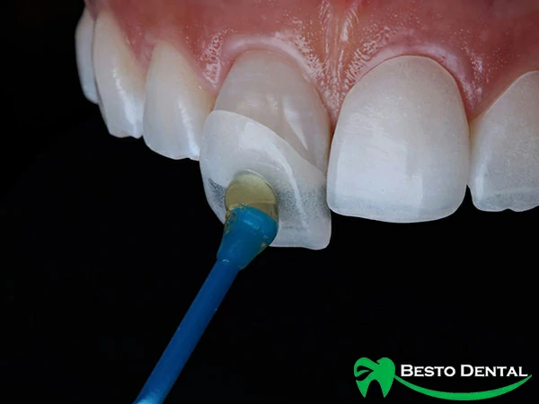 dental veneer
