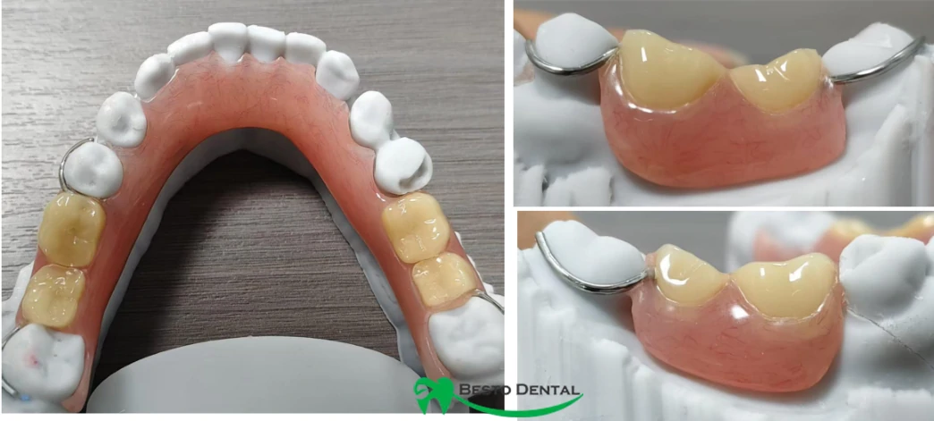 Acrylic Partial Dentures