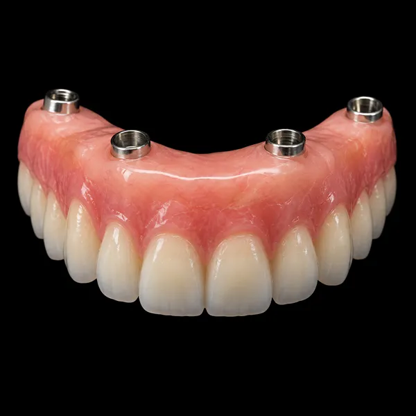 All-on-4 PFM Implant Bridge01