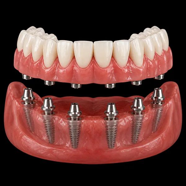 All-on-6 PFM Implant Bridge01