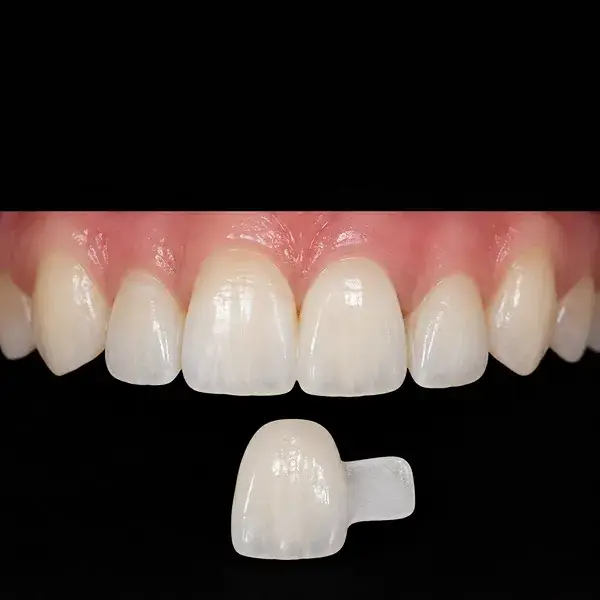 Anterior Single-Wing Zirconia Maryland Bridge
