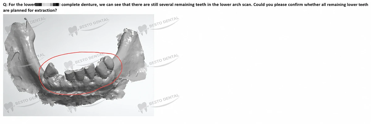 Are there other teeth that must be removed before the placement of a full‑arch restoration