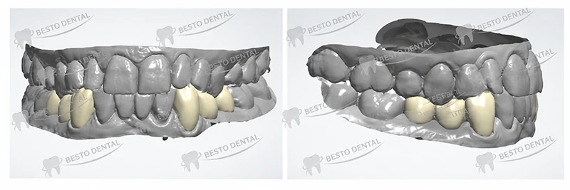 Can I review the CAD design before the dental bridge is manufactured