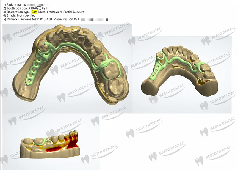 BestoDental will send the design drawing of the metal framework to the client for review; we will proceed with fabrication only after confirmation that everything is correct.