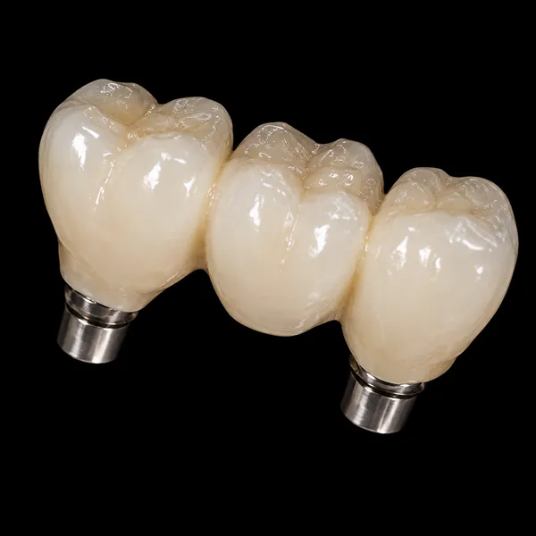 Cement-Retained PFM Implant Bridge