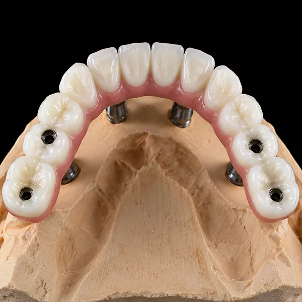 Co-Cr Full-Arch PFM Implant Bridge