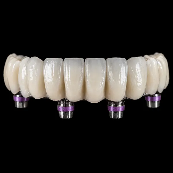 Co-Cr PFM Implant Bridge