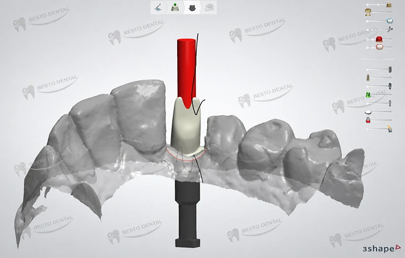 Custom Abutment Design