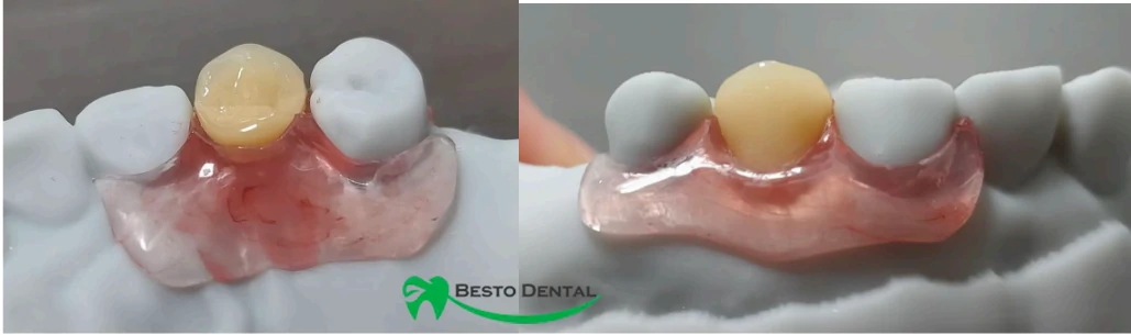 Flexible Partial Dentures