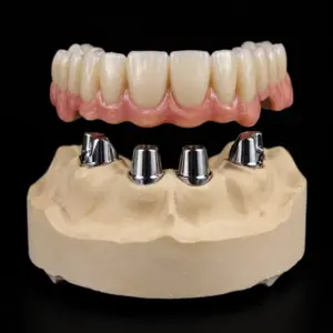Implant-Supported PFM Telescopic Crown