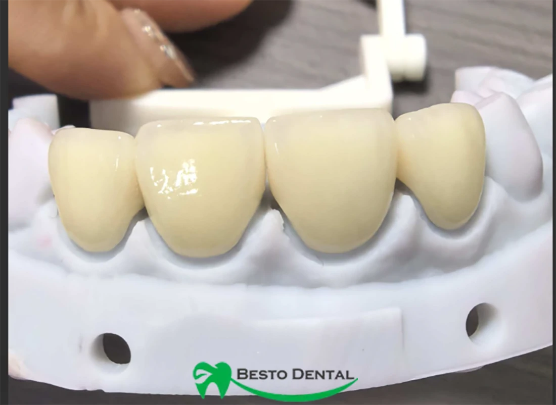 Layered Zirconia product