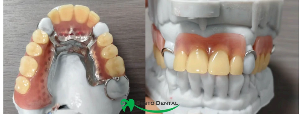 Metal Framework Partial Dentures