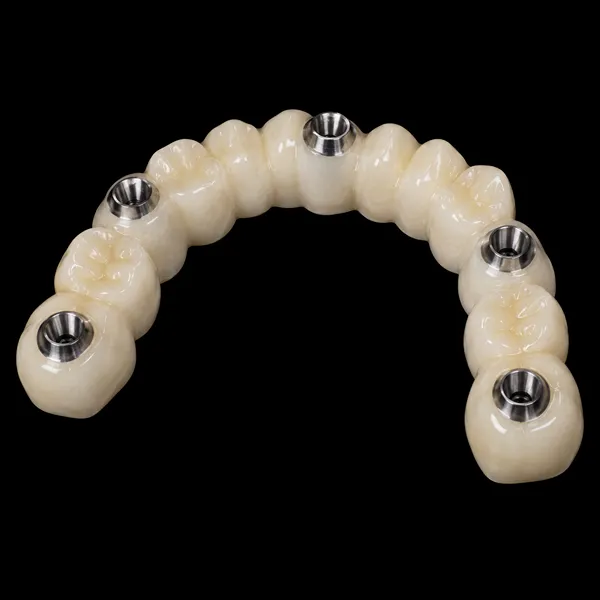 Multi-Unit PFM Implant Bridge