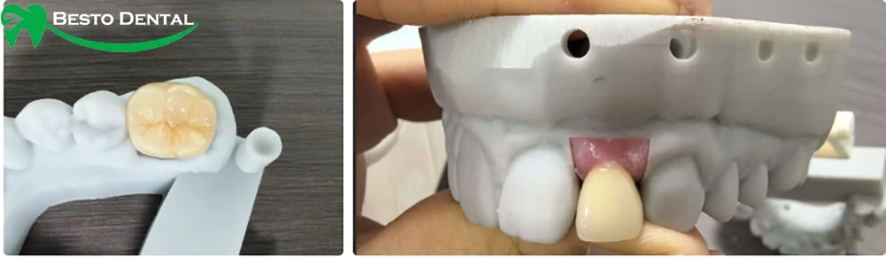 Multilayer Zirconia